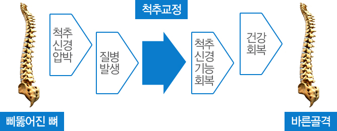 삐뚤어진뼈/바른골격